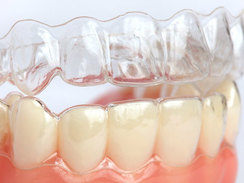 Clear Aligners