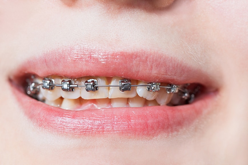 Damon Braces Damon Braces