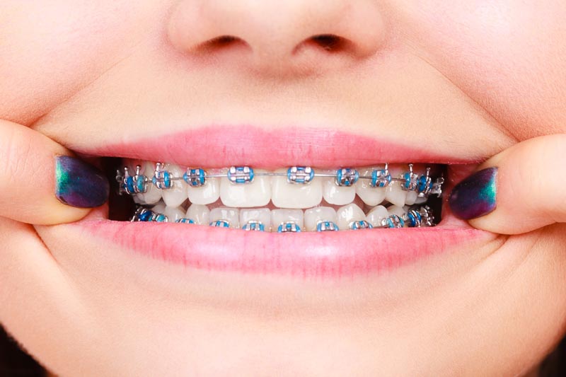 Traditional Braces Traditional Braces